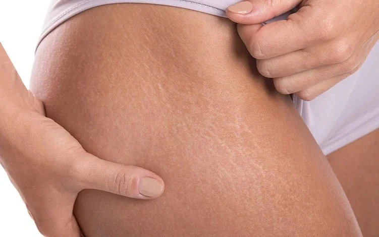 Linhas e marcas de estrias na pele